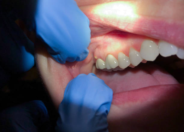 Best Emergency Wisdom Teeth Removal in Atkins, VA