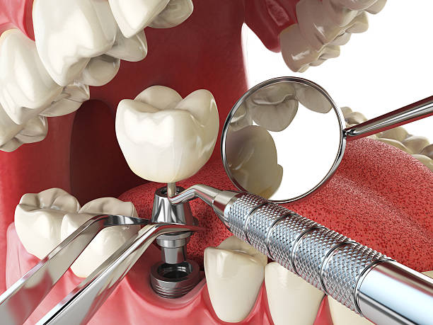 Best Emergency Tooth Extraction in Atkins, VA